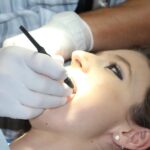 Le blanchiment dentaire américain : une technique très tendance